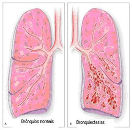 Bronquiectasias