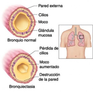 Bronquiectasias