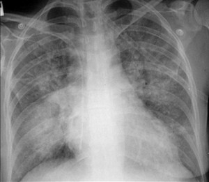 bronconeumonia multifocal