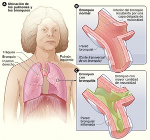 Bronquitis