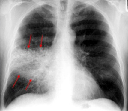 neumonia lobar