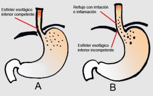 Reflujo grastroesofágico infantil Fisiopulmonar 02