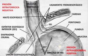 reflujo gastroesofagico esquema