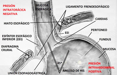 reflujo gastroesofagico esquema